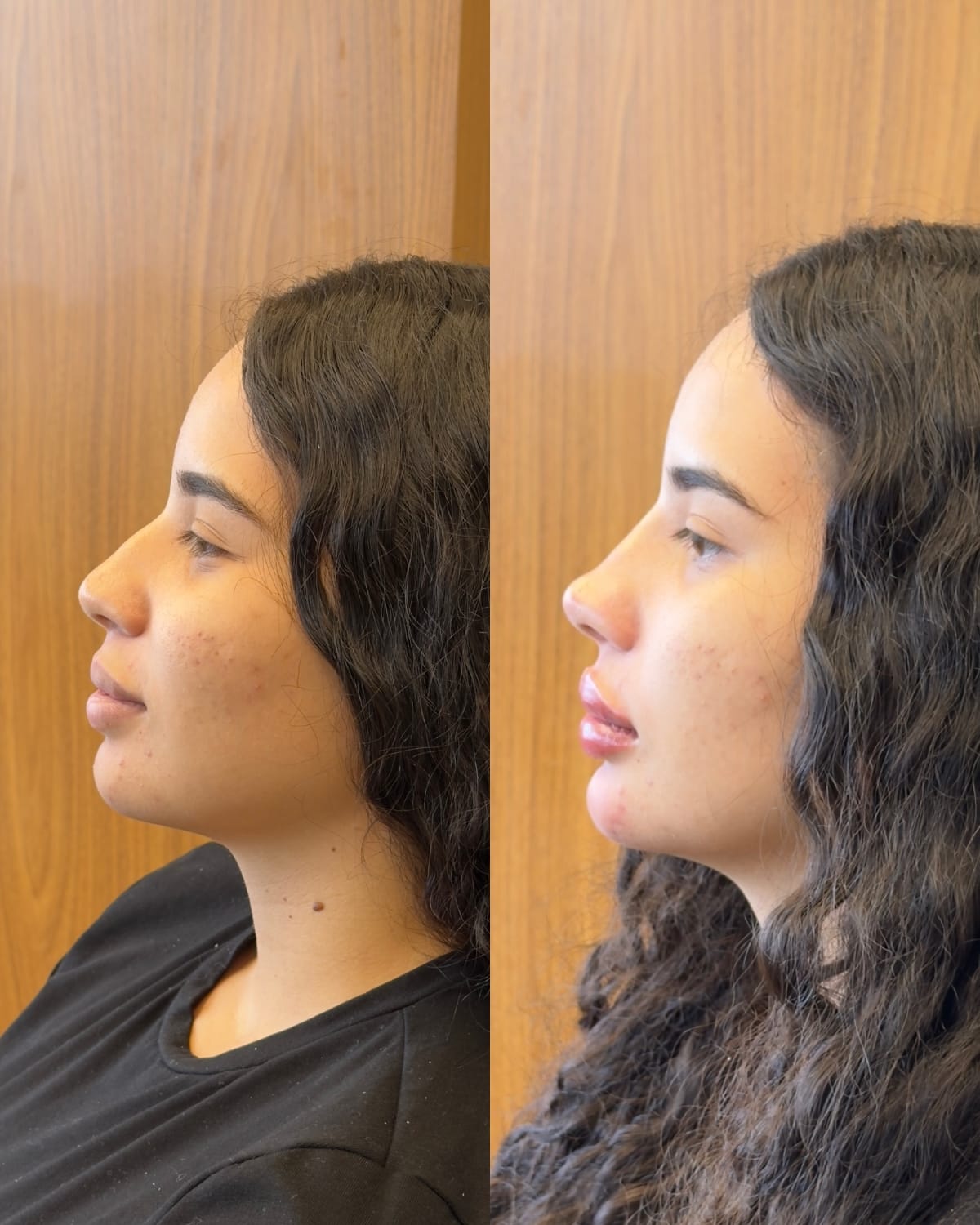 Segundo comparativo de perfil facial antes e depois do tratamento